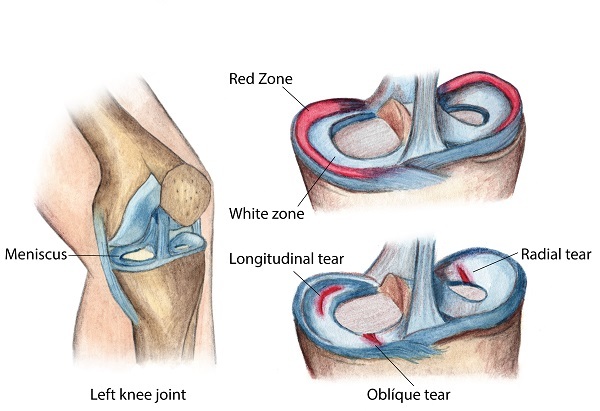 torn meniscus